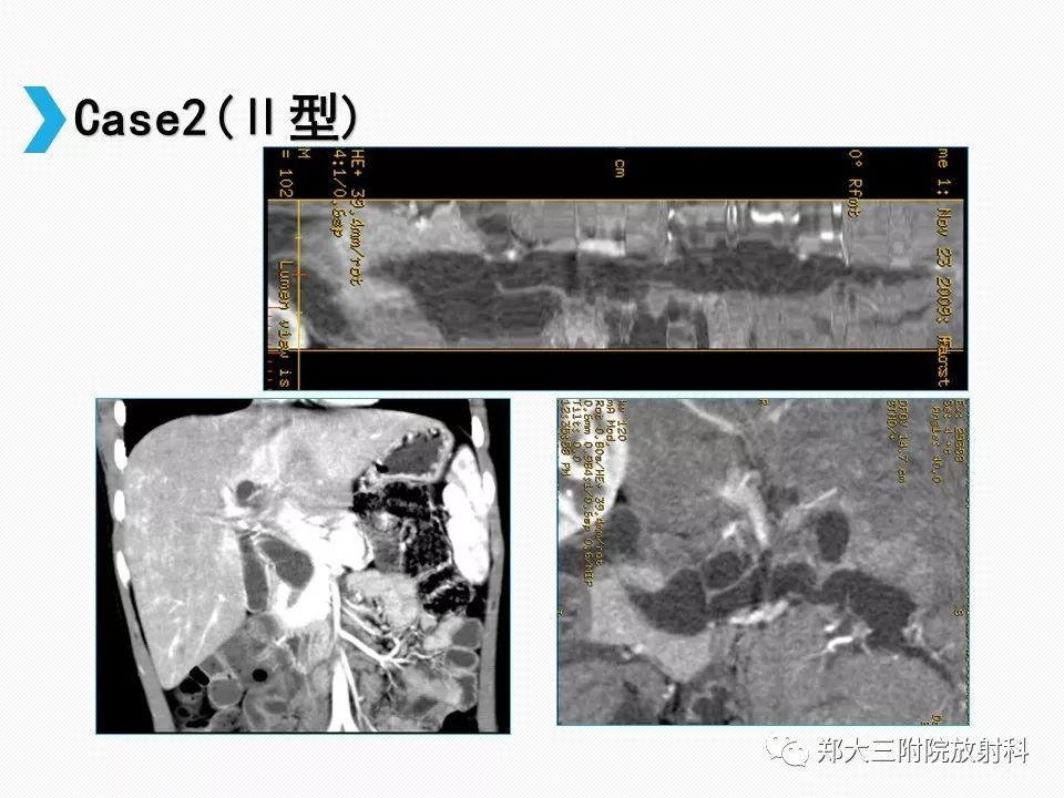 【PPT】小儿先天性胆总管囊肿CT诊断 【PPT】小儿先天性胆总管囊肿CT诊断