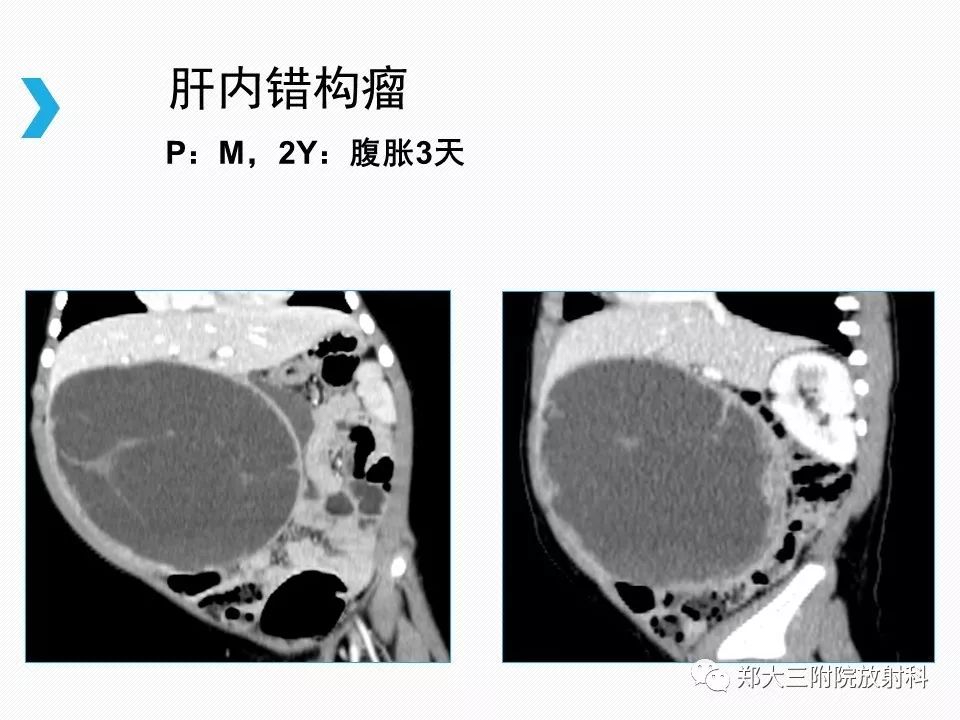 【PPT】小儿先天性胆总管囊肿CT诊断 【PPT】小儿先天性胆总管囊肿CT诊断