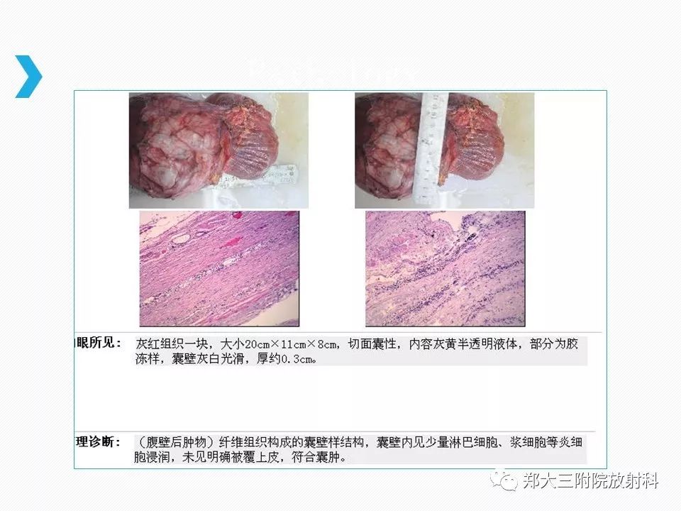 【PPT】小儿先天性胆总管囊肿CT诊断 【PPT】小儿先天性胆总管囊肿CT诊断