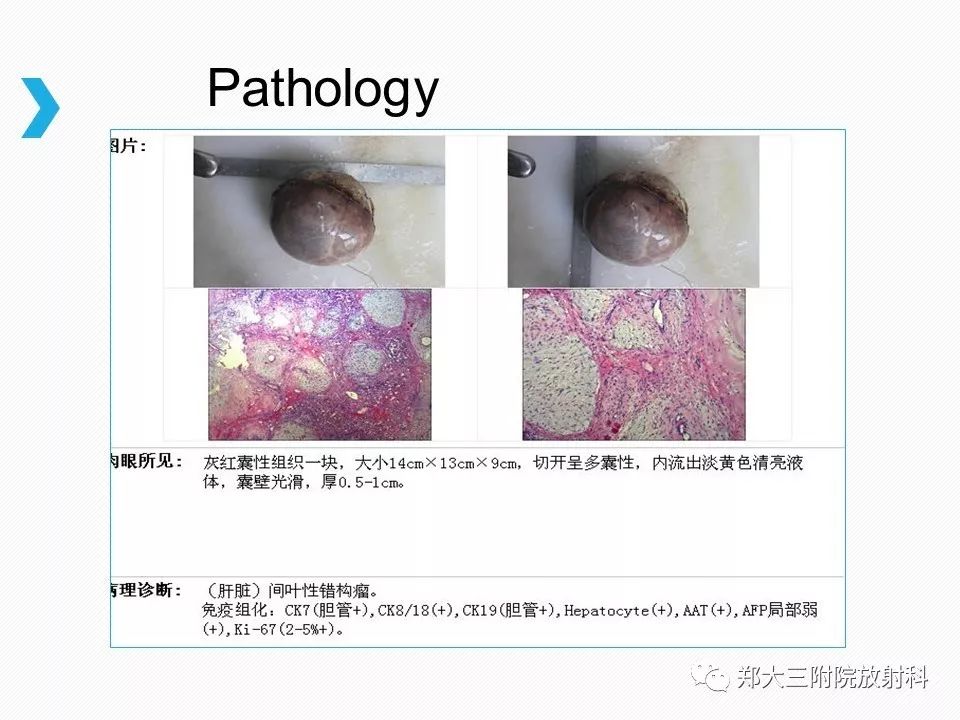 【PPT】小儿先天性胆总管囊肿CT诊断 【PPT】小儿先天性胆总管囊肿CT诊断