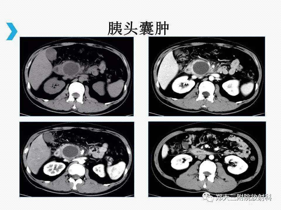 【PPT】小儿先天性胆总管囊肿CT诊断 【PPT】小儿先天性胆总管囊肿CT诊断