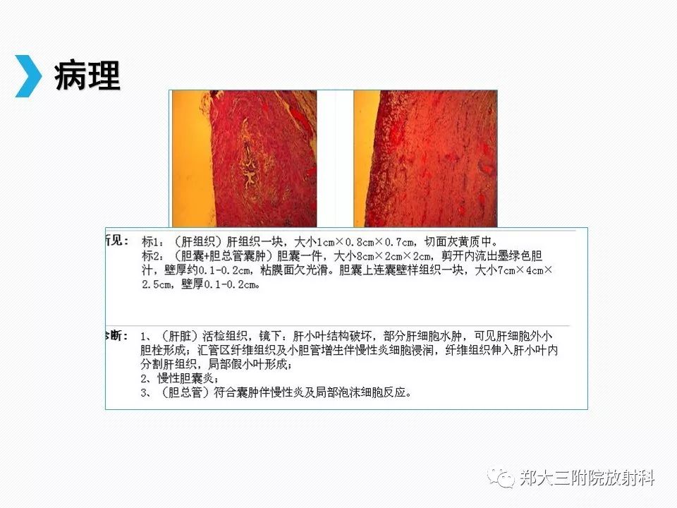 【PPT】小儿先天性胆总管囊肿CT诊断 【PPT】小儿先天性胆总管囊肿CT诊断