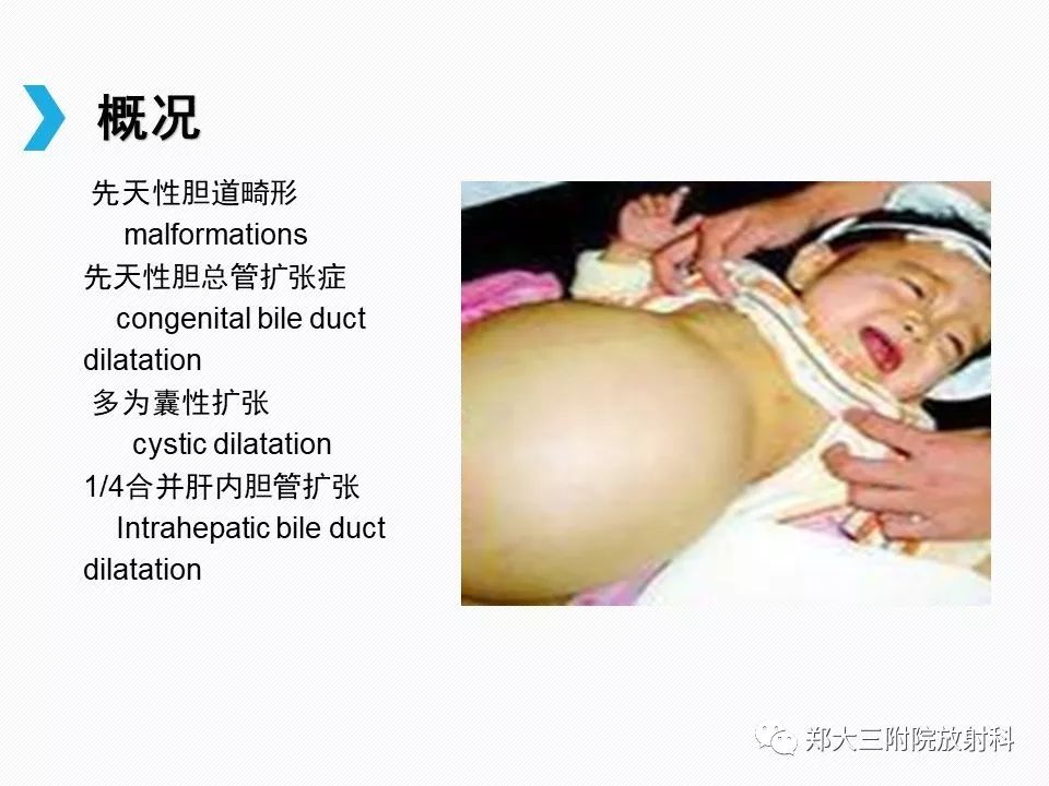 【PPT】小儿先天性胆总管囊肿CT诊断 【PPT】小儿先天性胆总管囊肿CT诊断