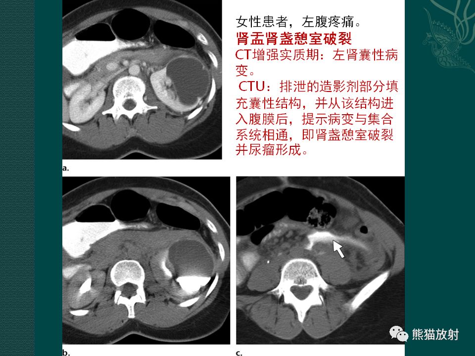 【PPT】肾脏囊性病变的CT及MRI表现 【PPT】肾脏囊性病变的CT及MRI表现