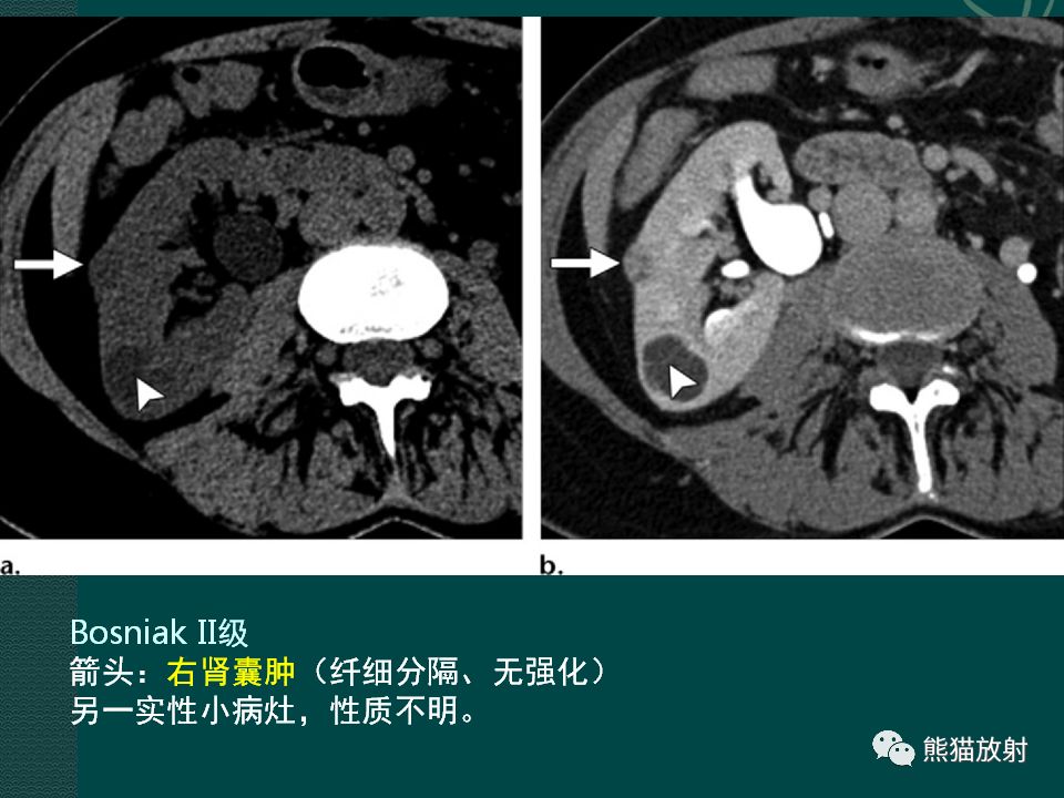 【PPT】肾脏囊性病变的CT及MRI表现 【PPT】肾脏囊性病变的CT及MRI表现