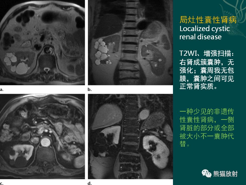 【PPT】肾脏囊性病变的CT及MRI表现 【PPT】肾脏囊性病变的CT及MRI表现