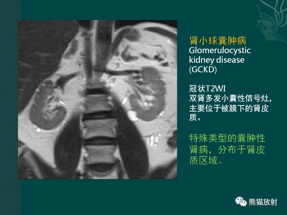 【PPT】肾脏囊性病变的CT及MRI表现 【PPT】肾脏囊性病变的CT及MRI表现