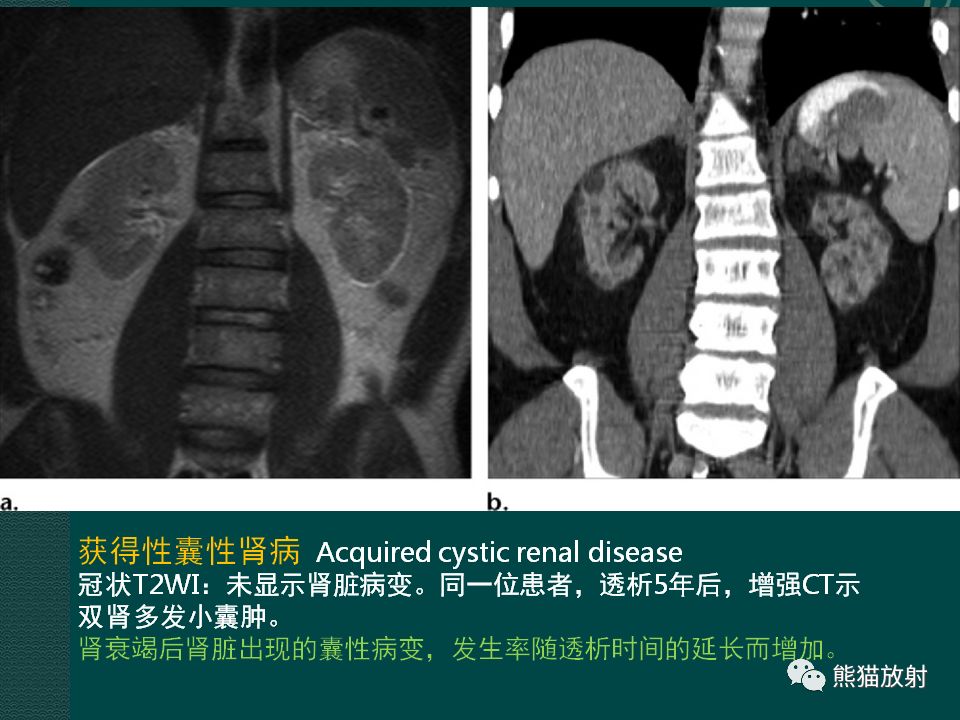 【PPT】肾脏囊性病变的CT及MRI表现 【PPT】肾脏囊性病变的CT及MRI表现