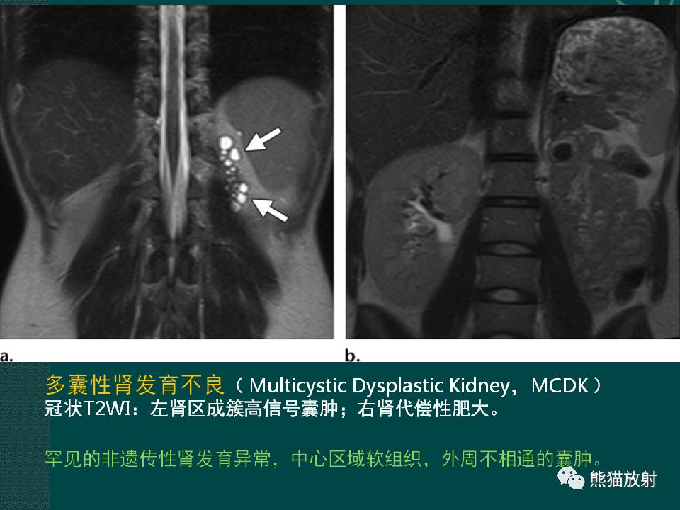 【PPT】肾脏囊性病变的CT及MRI表现 【PPT】肾脏囊性病变的CT及MRI表现