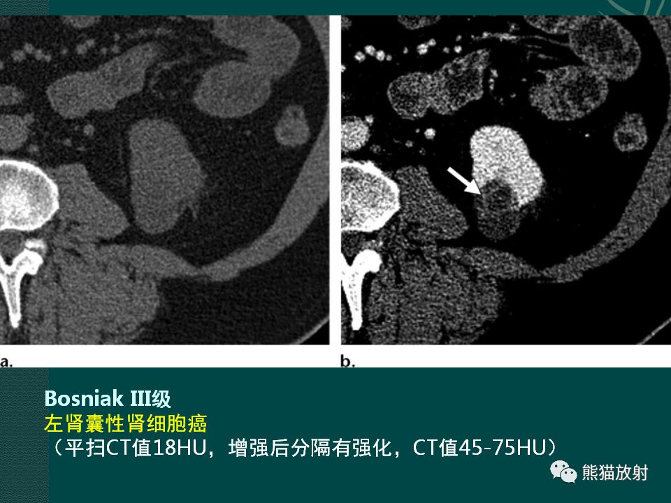 【PPT】肾脏囊性病变的CT及MRI表现 【PPT】肾脏囊性病变的CT及MRI表现
