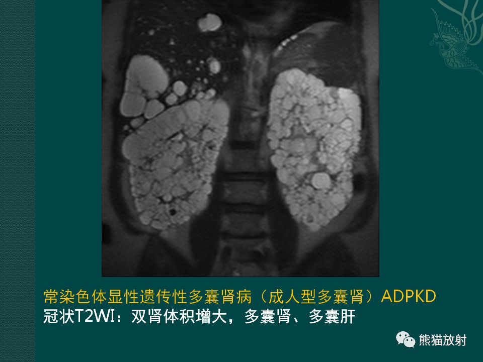 【PPT】肾脏囊性病变的CT及MRI表现 【PPT】肾脏囊性病变的CT及MRI表现