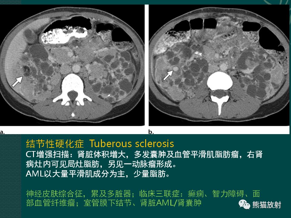 【PPT】肾脏囊性病变的CT及MRI表现 【PPT】肾脏囊性病变的CT及MRI表现