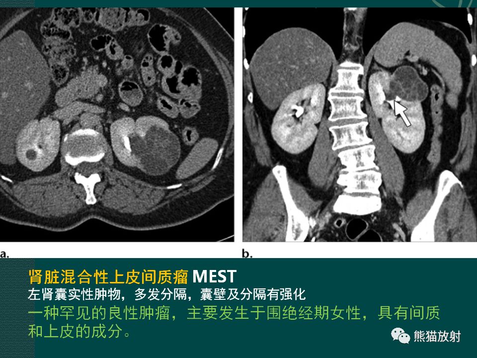 【PPT】肾脏囊性病变的CT及MRI表现 【PPT】肾脏囊性病变的CT及MRI表现