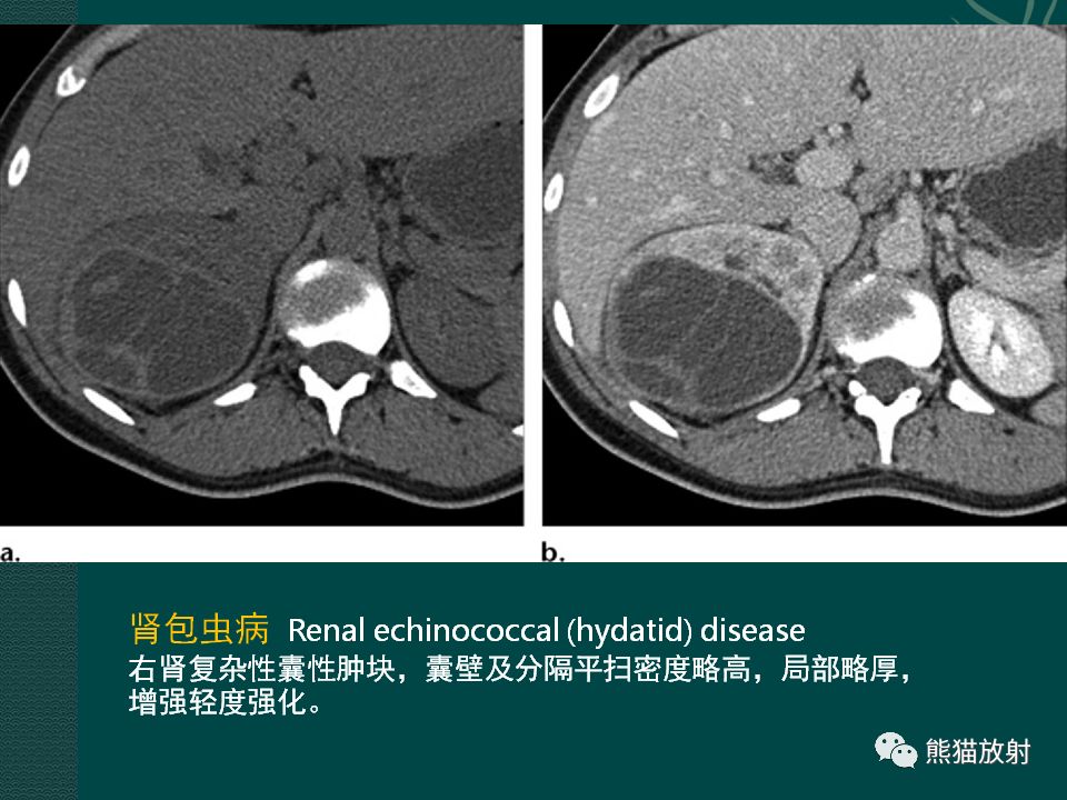 【PPT】肾脏囊性病变的CT及MRI表现 【PPT】肾脏囊性病变的CT及MRI表现
