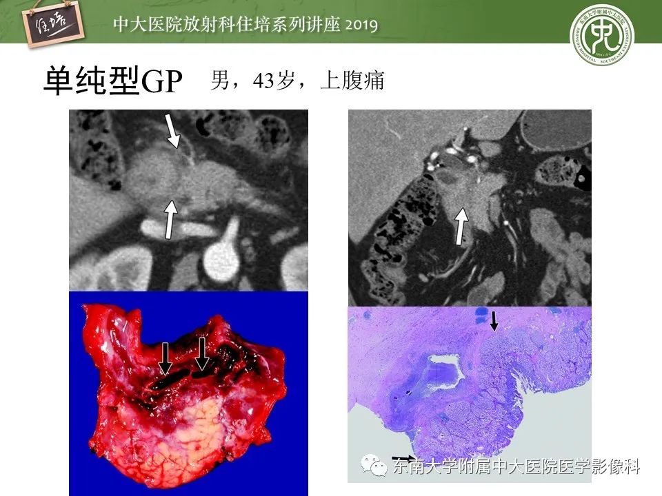 【PPT】胰腺炎的影像评估
