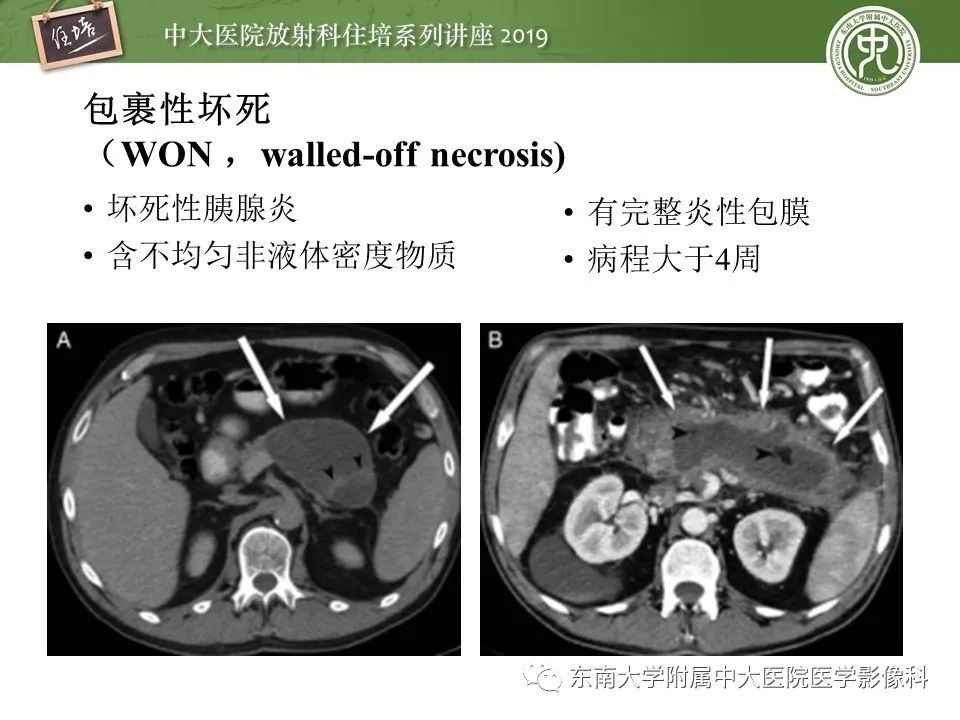 【PPT】胰腺炎的影像评估