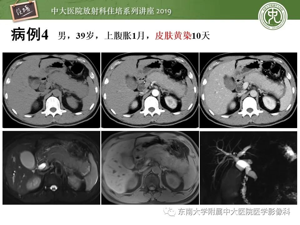 【PPT】胰腺炎的影像评估