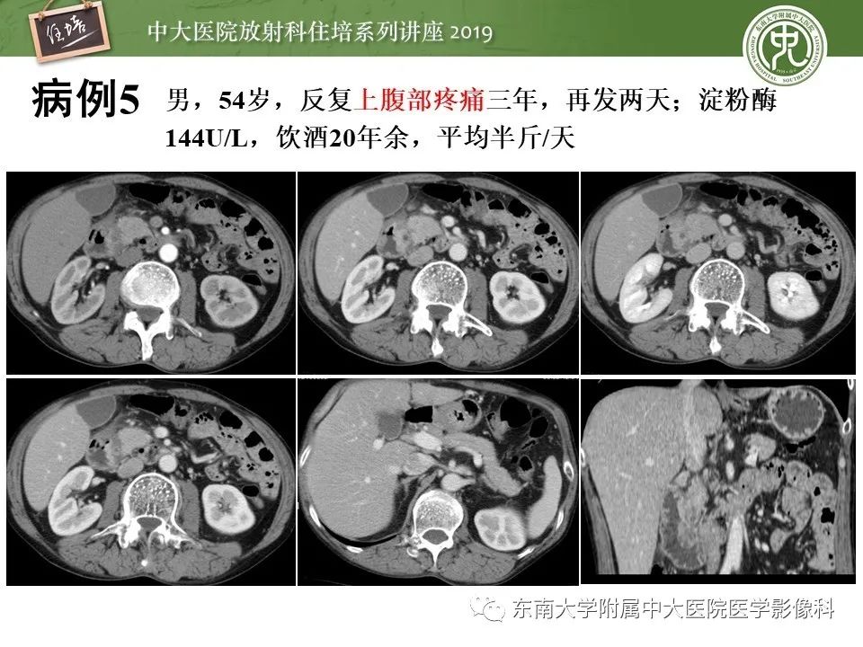 【PPT】胰腺炎的影像评估