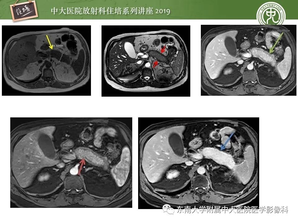 【PPT】胰腺炎的影像评估