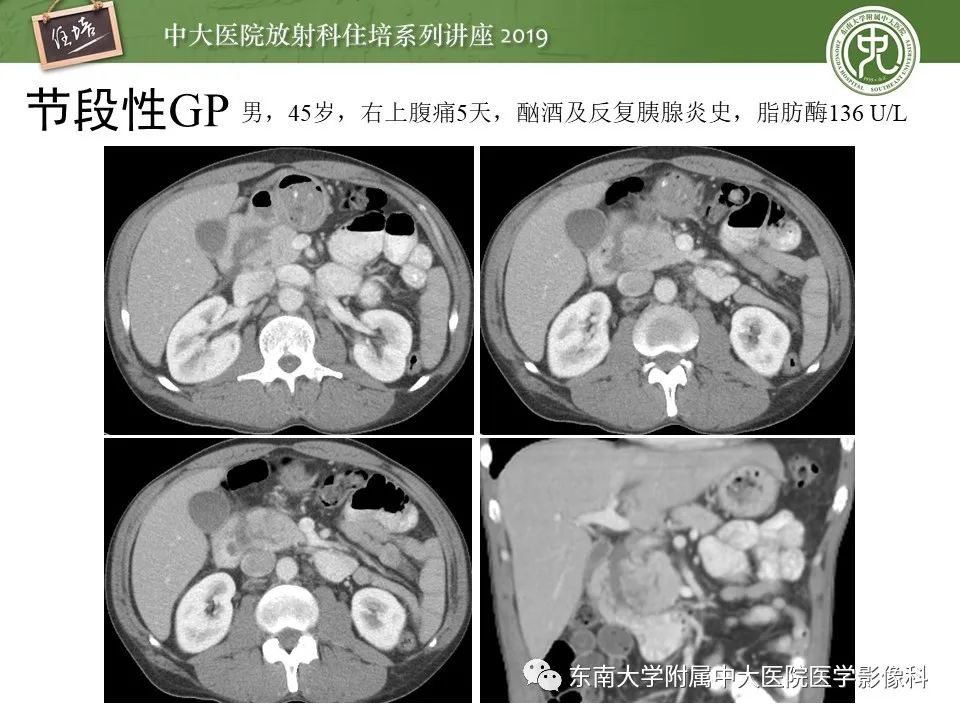【PPT】胰腺炎的影像评估