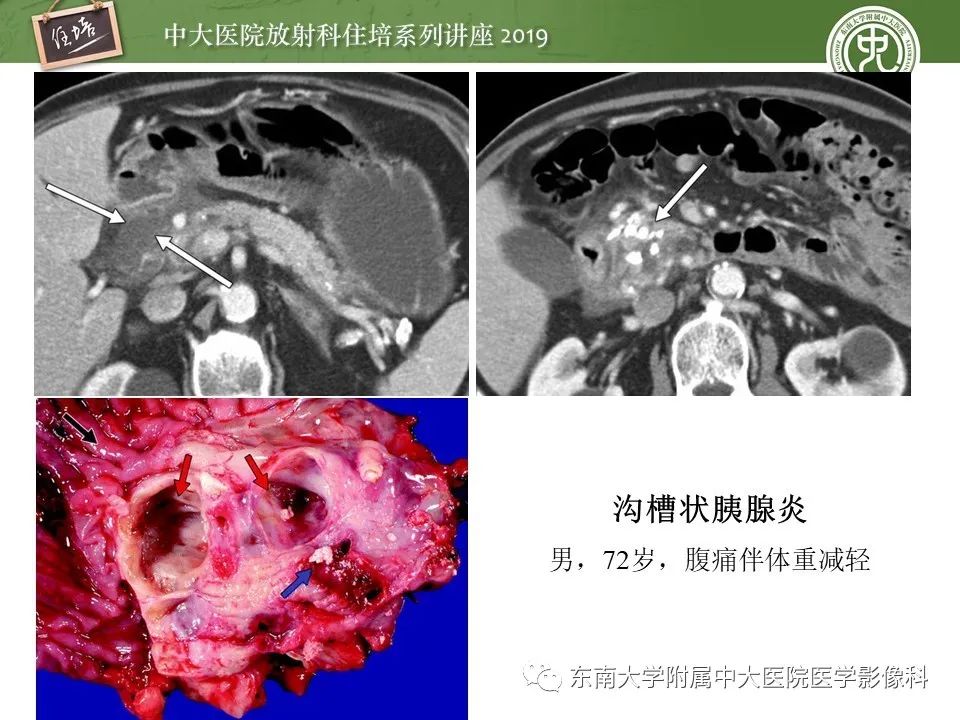 【PPT】胰腺炎的影像评估