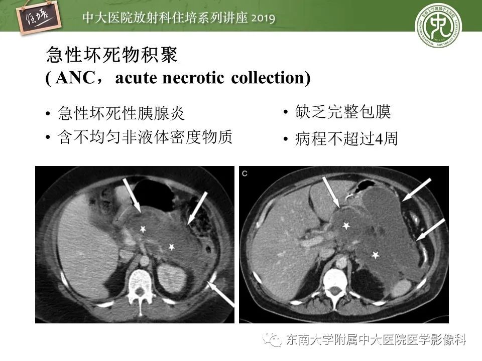 【PPT】胰腺炎的影像评估