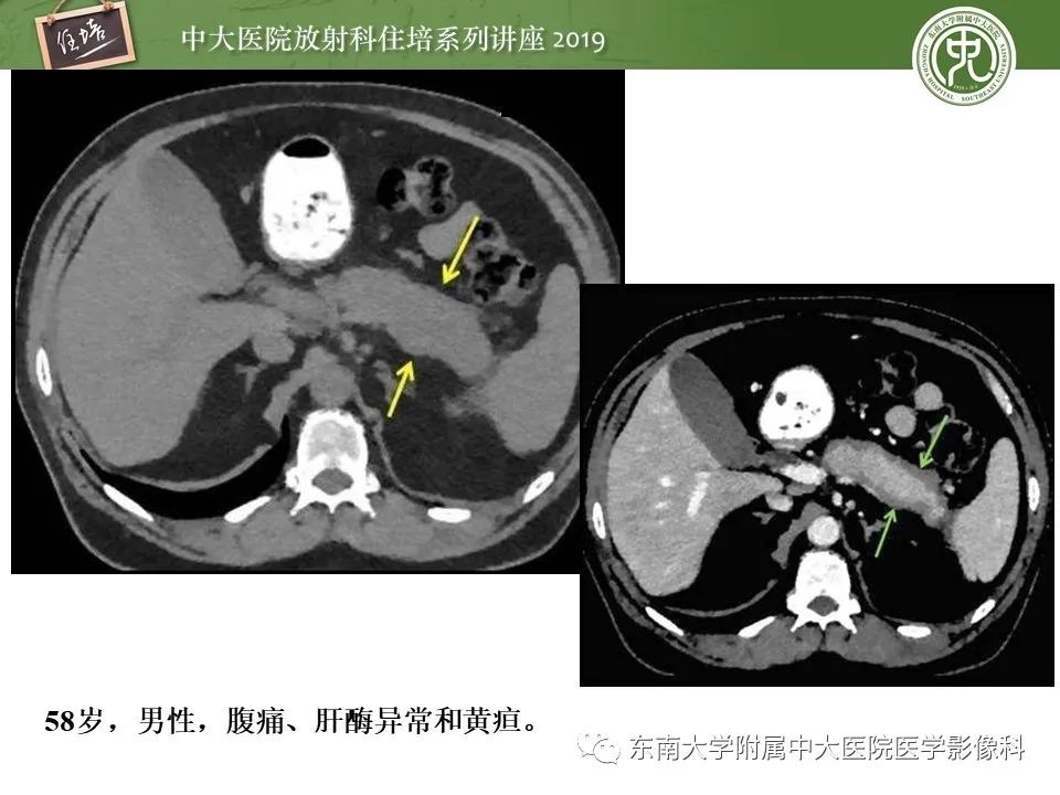 【PPT】胰腺炎的影像评估