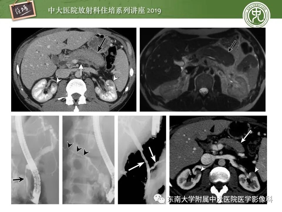 【PPT】胰腺炎的影像评估