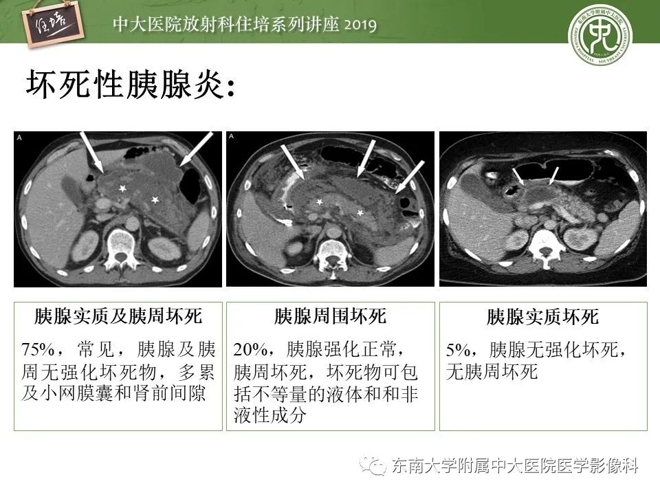 【PPT】胰腺炎的影像评估