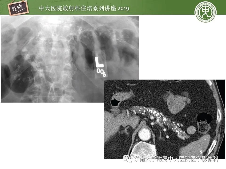【PPT】胰腺炎的影像评估