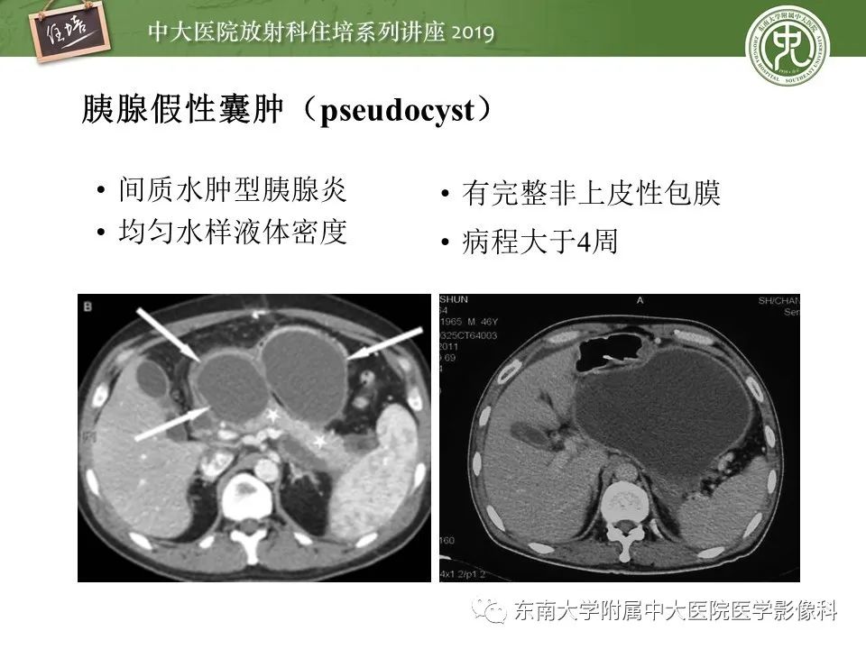 【PPT】胰腺炎的影像评估