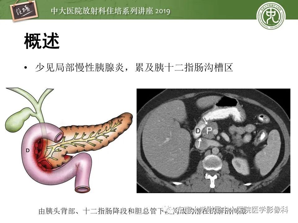 【PPT】胰腺炎的影像评估