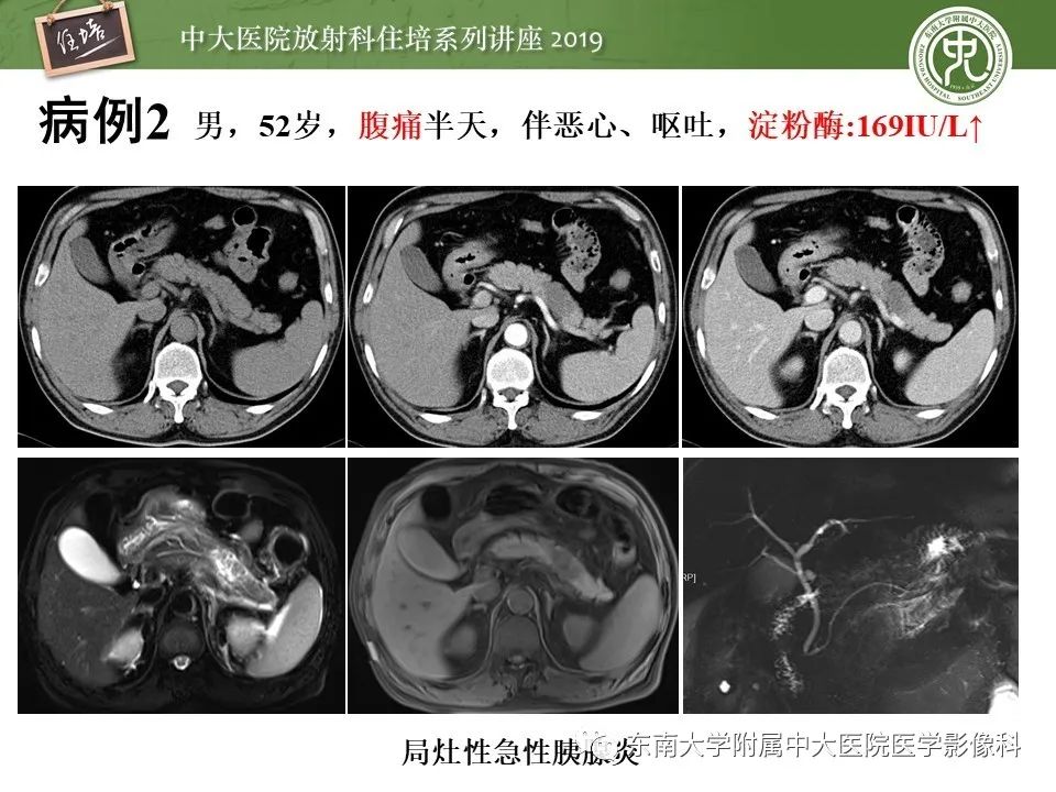 【PPT】胰腺炎的影像评估