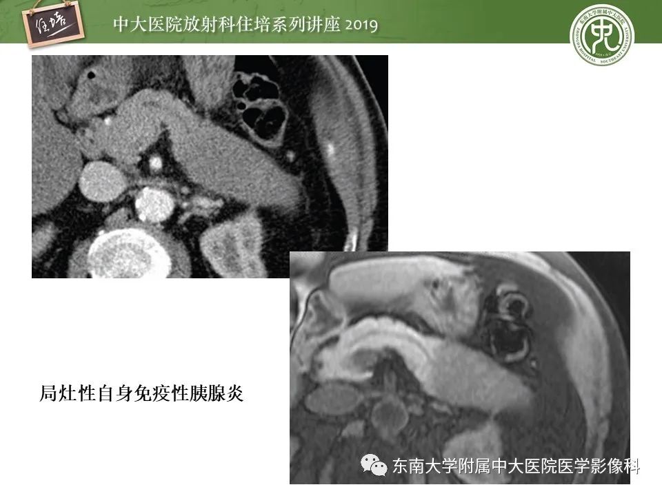 【PPT】胰腺炎的影像评估