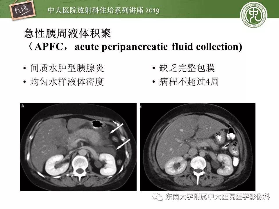 【PPT】胰腺炎的影像评估
