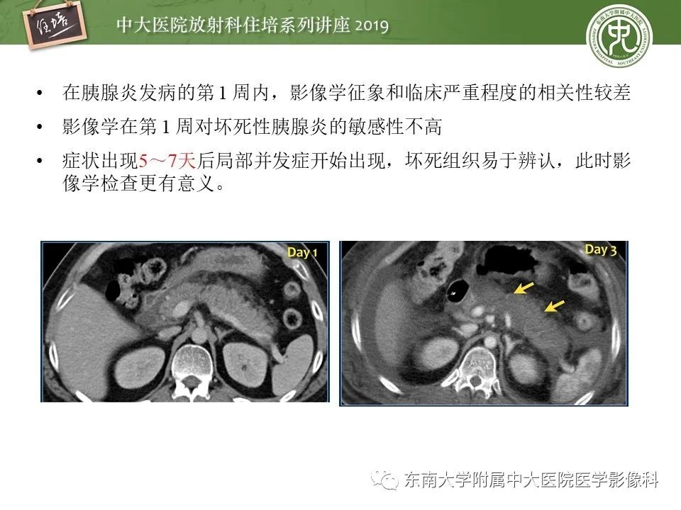 【PPT】胰腺炎的影像评估