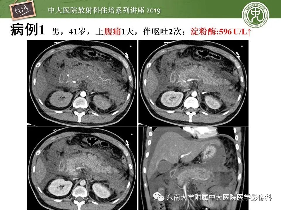 【PPT】胰腺炎的影像评估