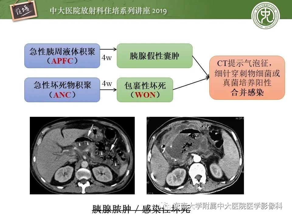 【PPT】胰腺炎的影像评估