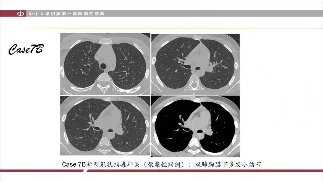 【PPT】NCP学习小结与病例分享