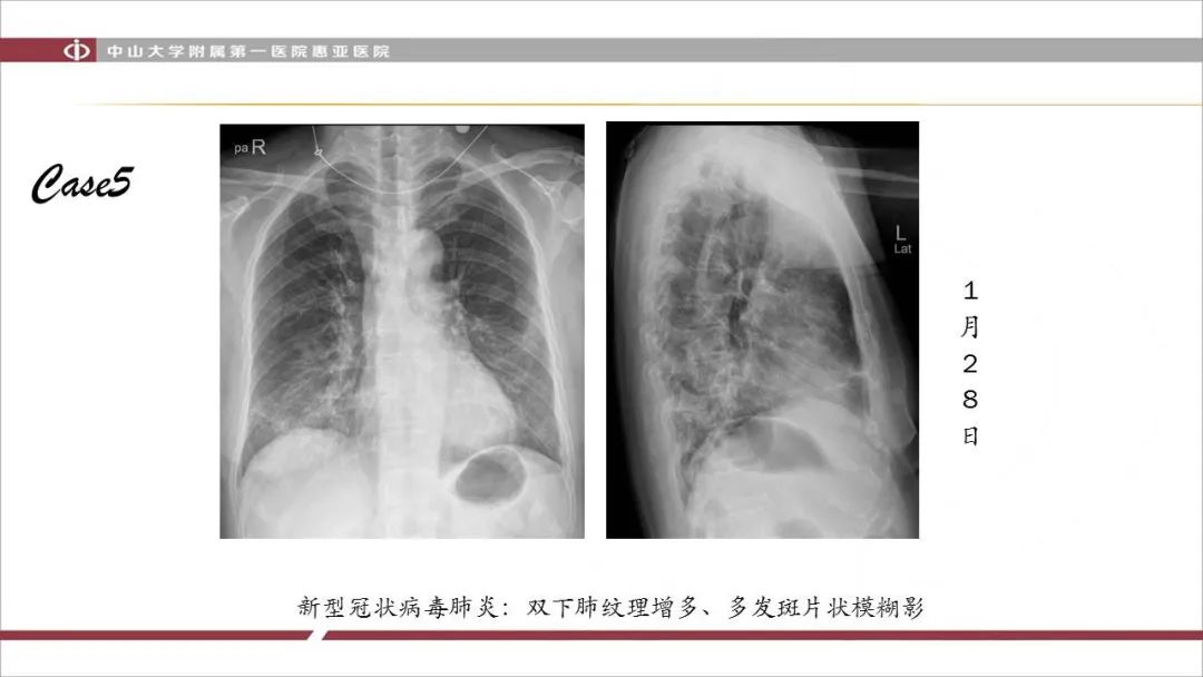 【PPT】NCP学习小结与病例分享