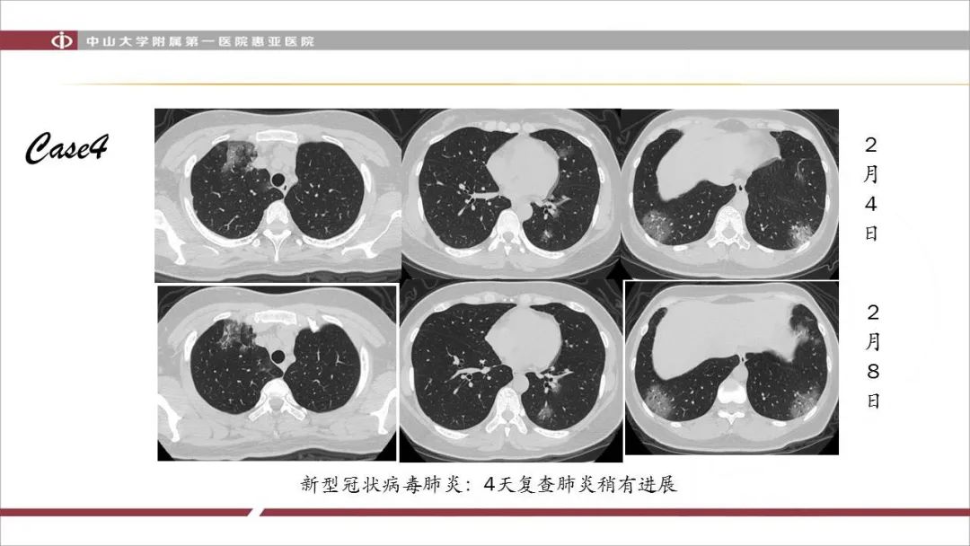 【PPT】NCP学习小结与病例分享