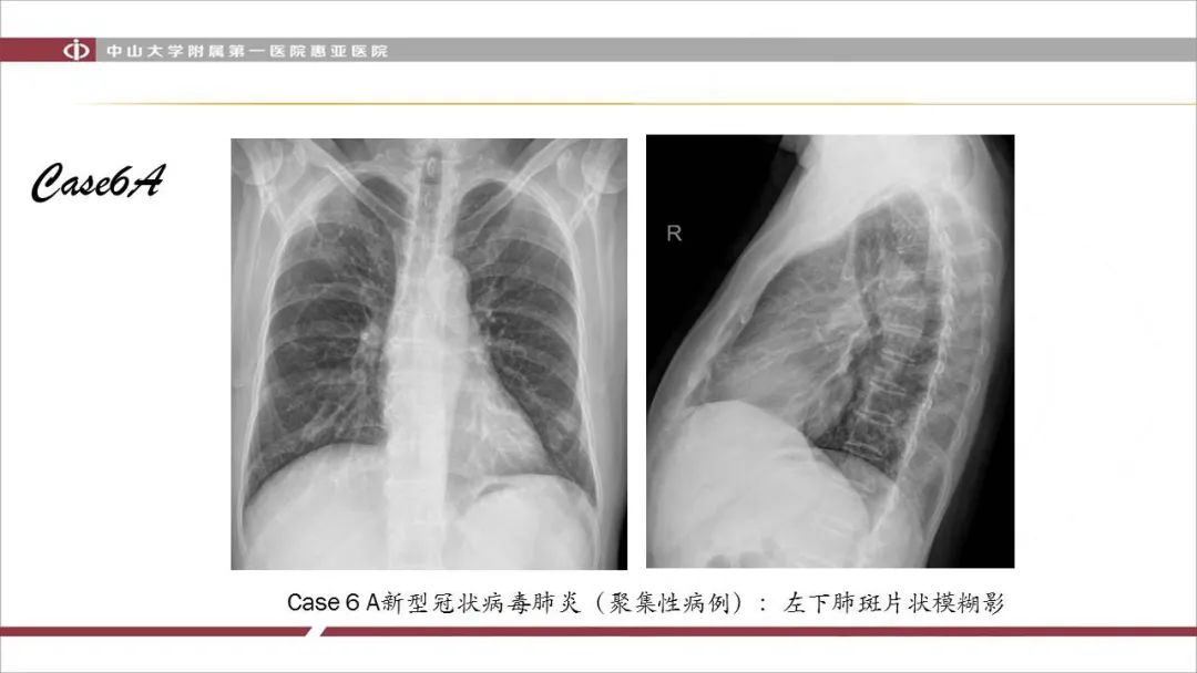 【PPT】NCP学习小结与病例分享