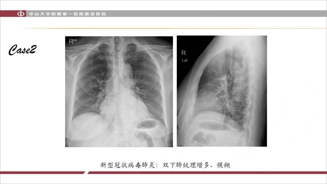 【PPT】NCP学习小结与病例分享