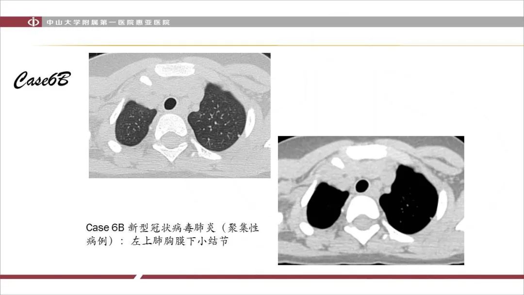 【PPT】NCP学习小结与病例分享