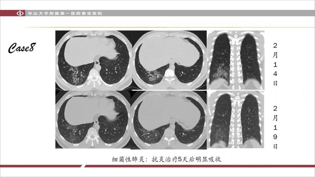 【PPT】NCP学习小结与病例分享