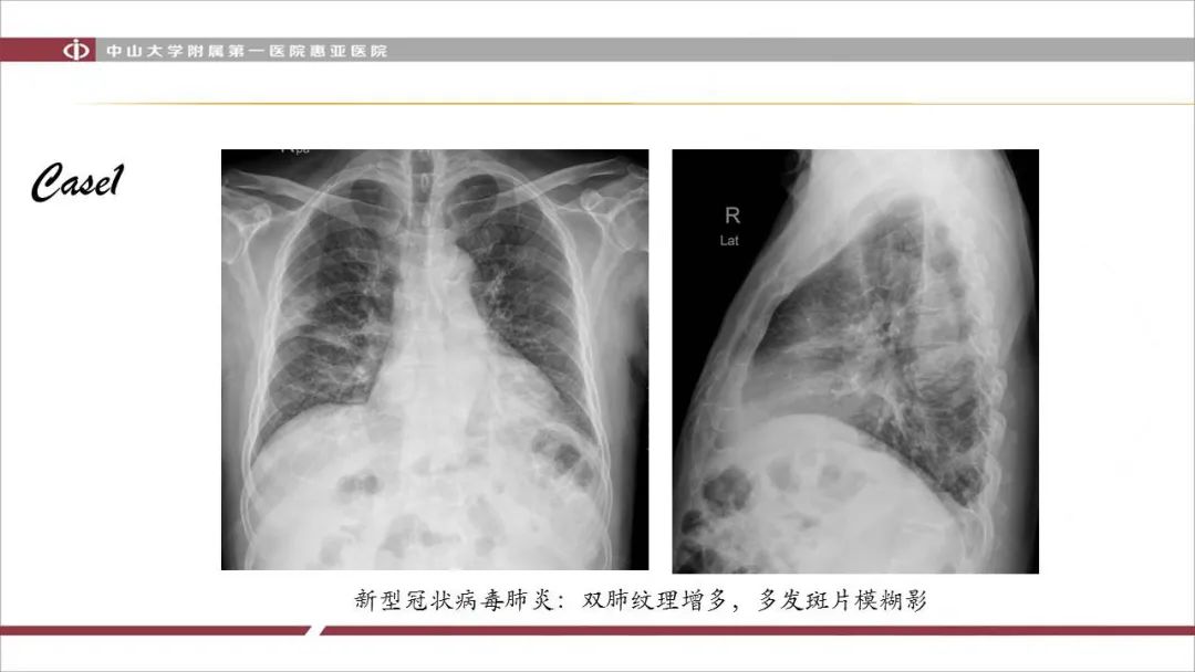 【PPT】NCP学习小结与病例分享
