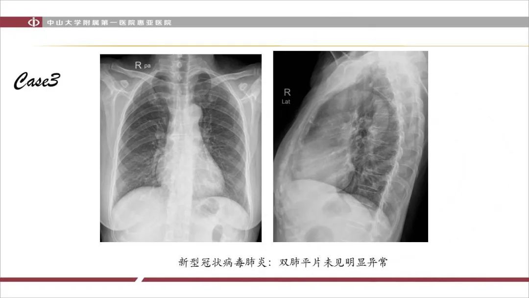 【PPT】NCP学习小结与病例分享