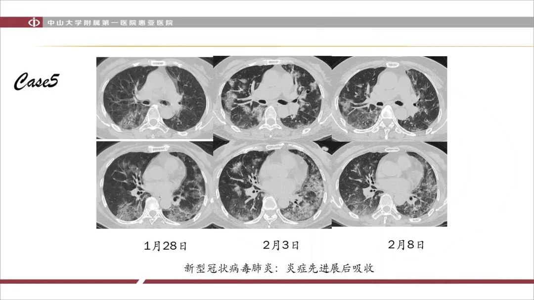 【PPT】NCP学习小结与病例分享