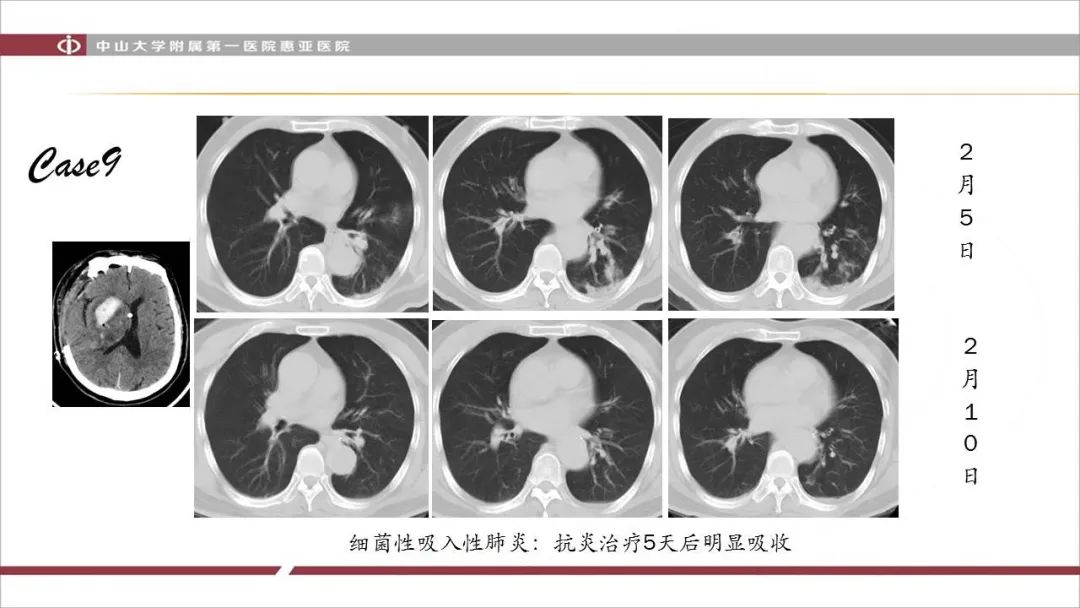 【PPT】NCP学习小结与病例分享