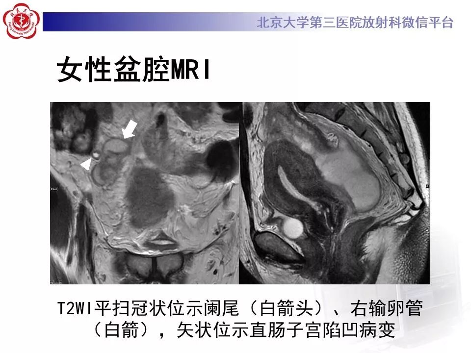 【病例】盆腔炎1例MR影像